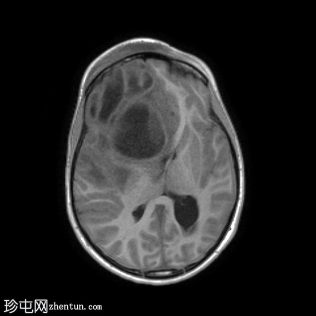 Pott浮肿性肿瘤伴脑脓肿