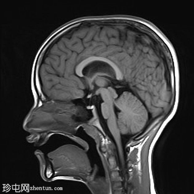 双侧Monro孔狭窄