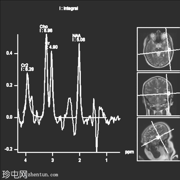 结核瘤