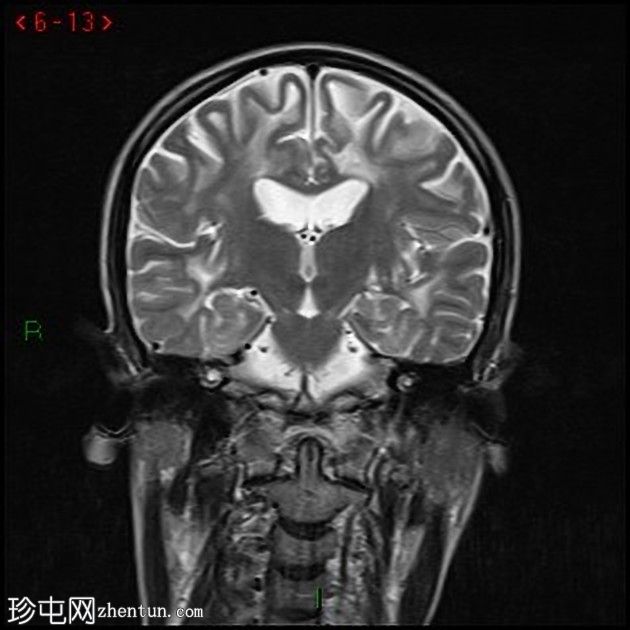 大脑常染色体显性动脉病伴皮质下梗死和白质脑病(CADASIL)