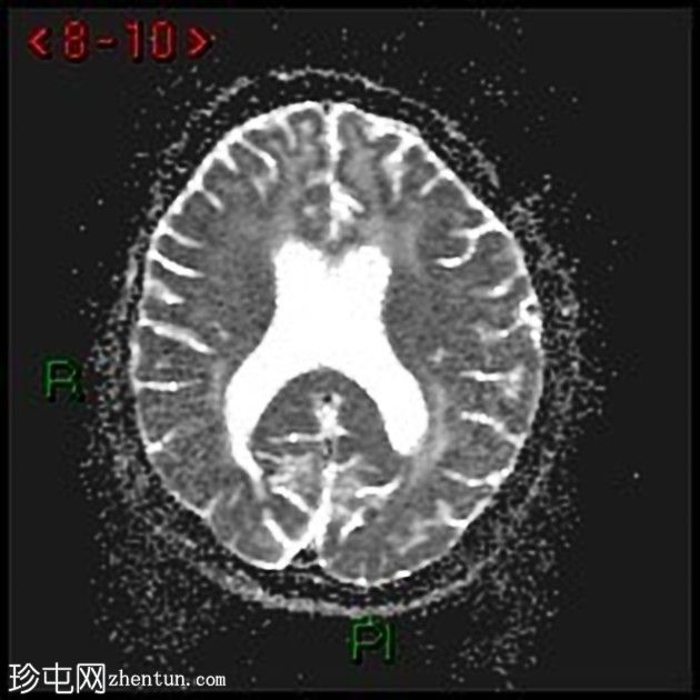 大脑常染色体显性动脉病伴皮质下梗死和白质脑病(CADASIL)