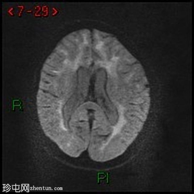 大脑常染色体显性动脉病伴皮质下梗死和白质脑病(CADASIL)