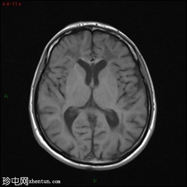 大脑常染色体显性动脉病伴皮质下梗死和白质脑病(CADASIL)