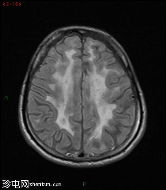 大脑常染色体显性动脉病伴皮质下梗死和白质脑病(CADASIL)