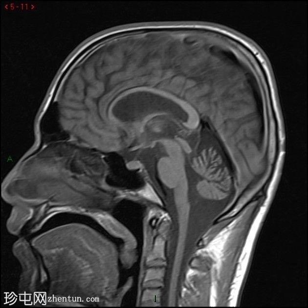 大脑常染色体显性动脉病伴皮质下梗死和白质脑病(CADASIL)