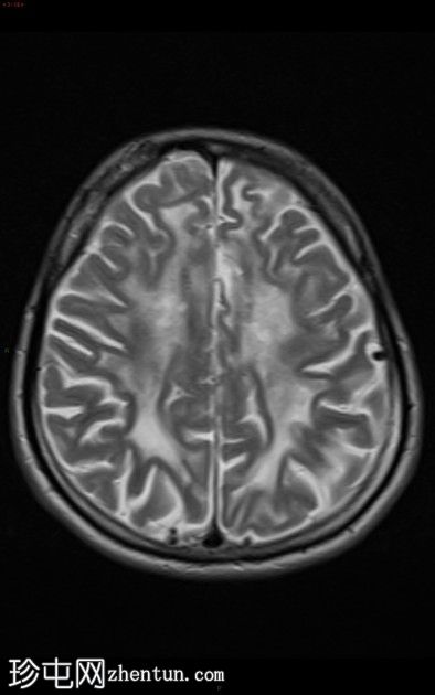 大脑常染色体显性动脉病伴皮质下梗死和白质脑病(CADASIL)