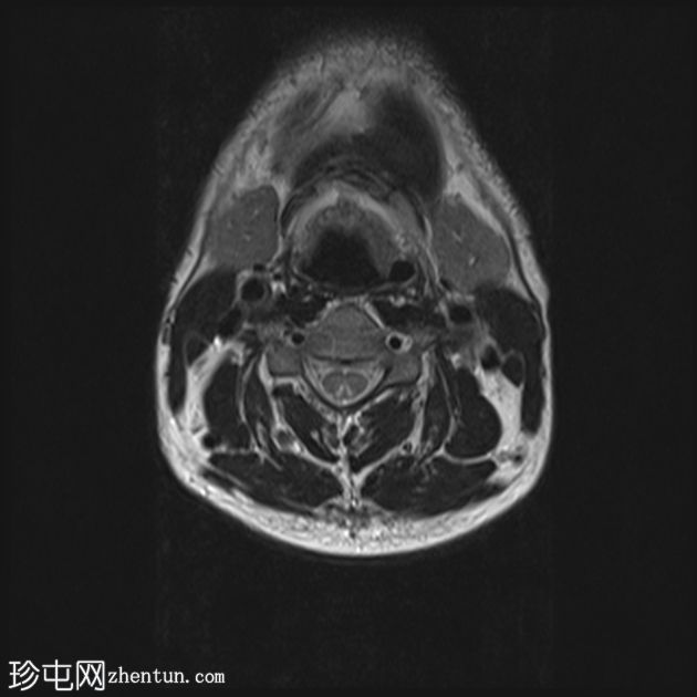 脊髓亚急性联合变性