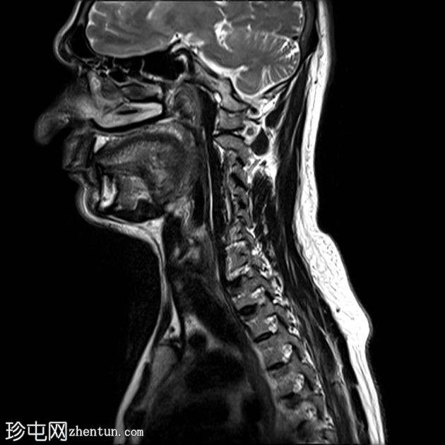 脊髓亚急性联合变性