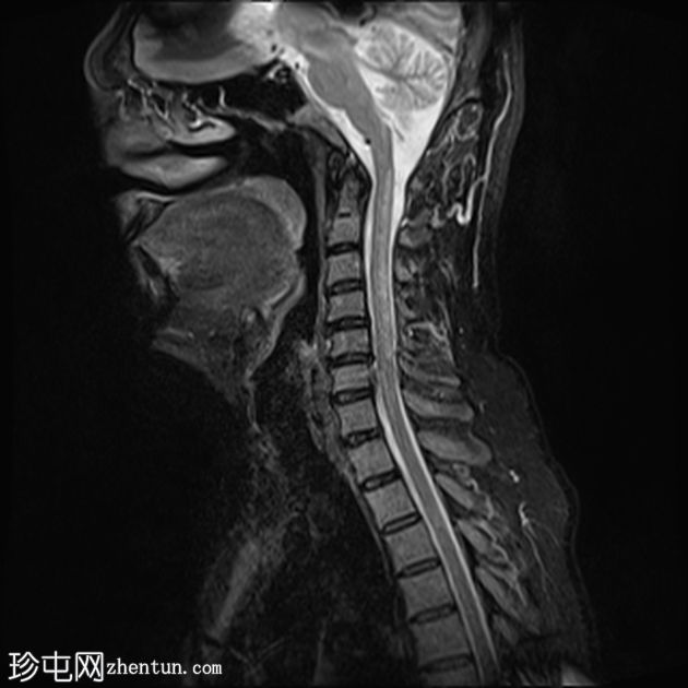 脊髓亚急性联合变性