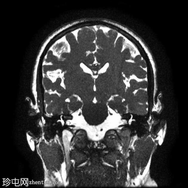 前庭导水管