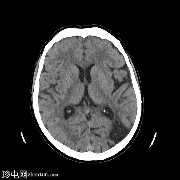 老年性分水岭梗死与偶发性静窦综合征