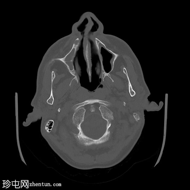 老年性分水岭梗死与偶发性静窦综合征