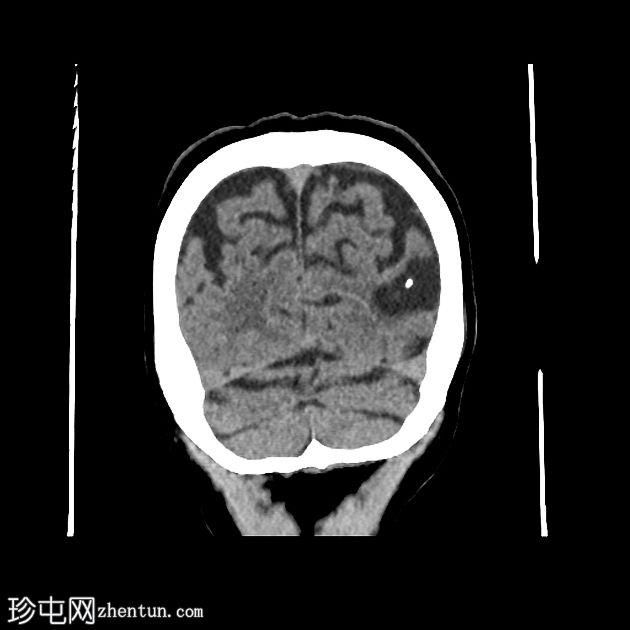 老年性分水岭梗死与偶发性静窦综合征