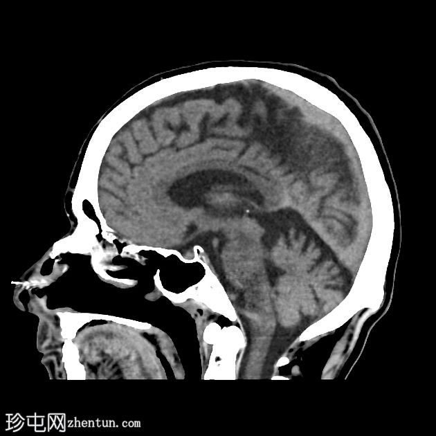 老年性分水岭梗死与偶发性静窦综合征