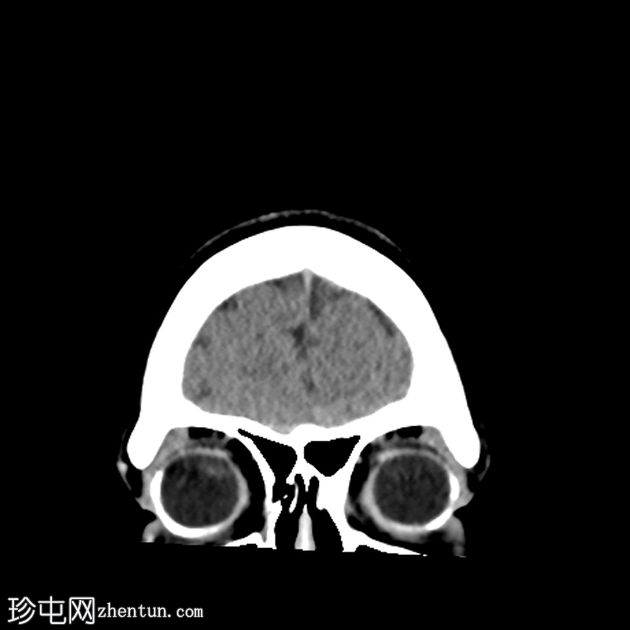 巩膜纹身-双侧