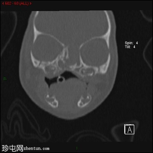 无鼻畸形