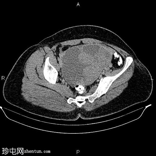 双侧卵巢浆液性囊腺癌