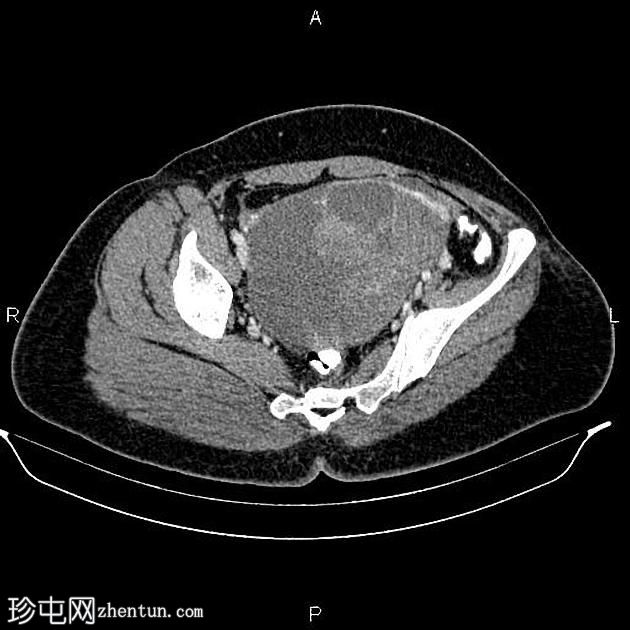 双侧卵巢浆液性囊腺癌