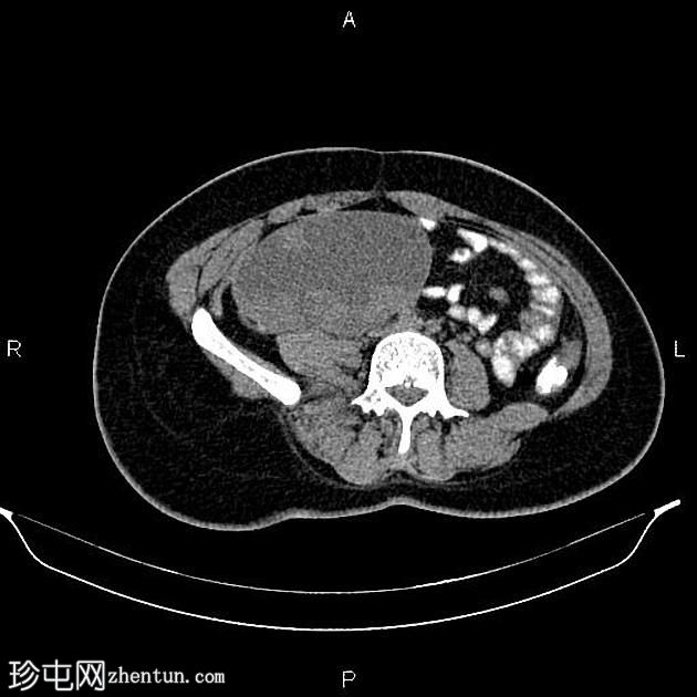双侧卵巢浆液性囊腺癌