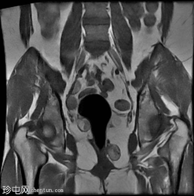 多发性盆腔肉芽肿