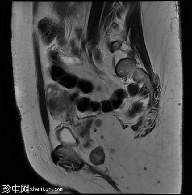 多发性盆腔肉芽肿