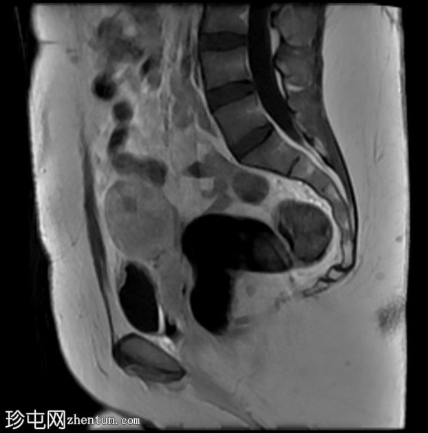 多发性盆腔肉芽肿