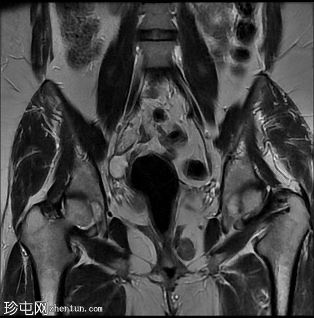 多发性盆腔肉芽肿