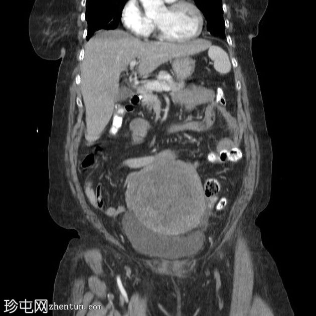 子宫、子宫颈和阴道的乳头状浆液性癌