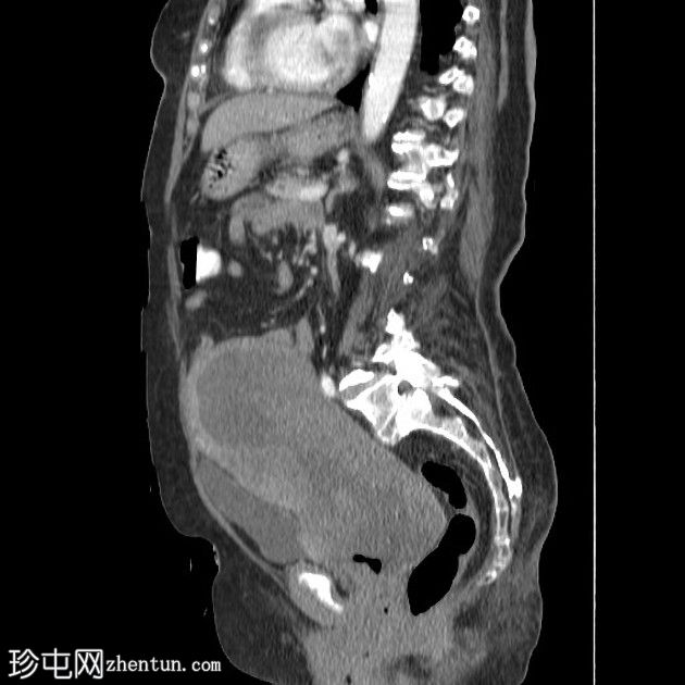 子宫、子宫颈和阴道的乳头状浆液性癌