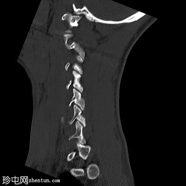 先天性C1 - Currarino后弓畸形D型