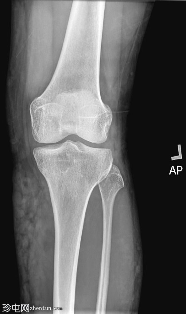 膝关节x光片显示静脉曲张
