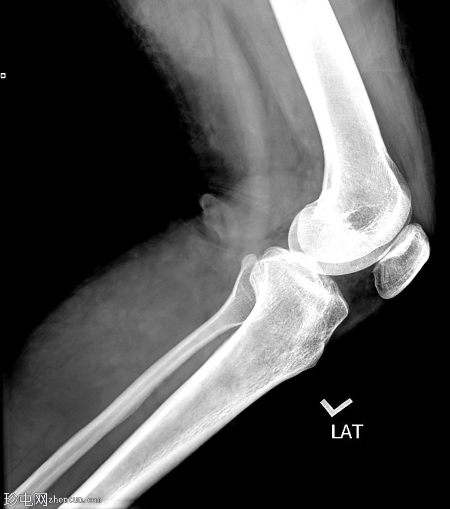 膝关节x光片显示静脉曲张