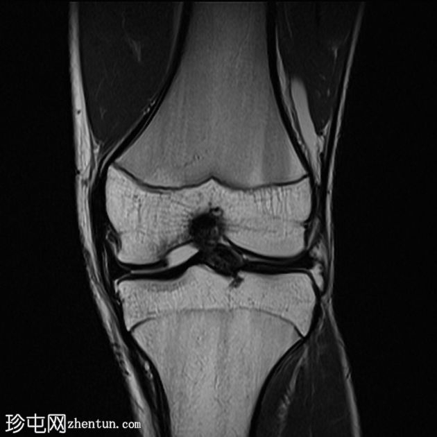 青少年剥脱性骨软骨炎