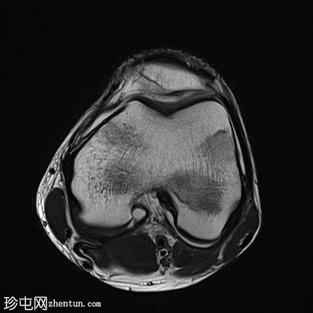 青少年剥脱性骨软骨炎