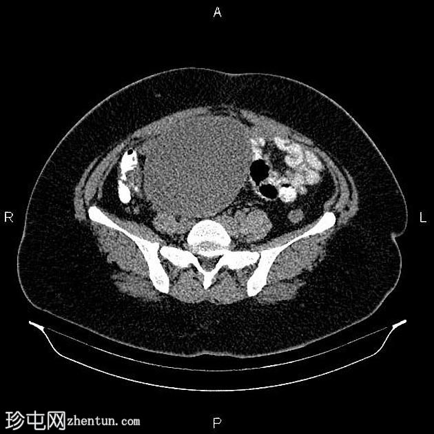 卵巢粘液性囊腺瘤