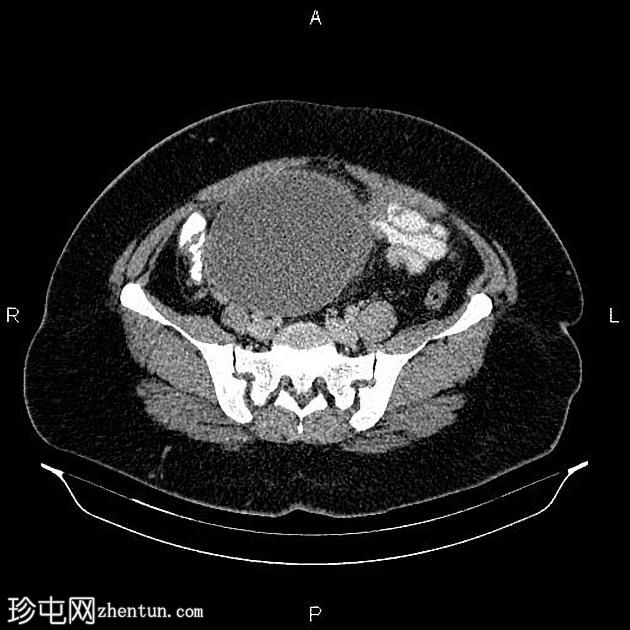 卵巢粘液性囊腺瘤