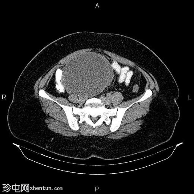 卵巢粘液性囊腺瘤