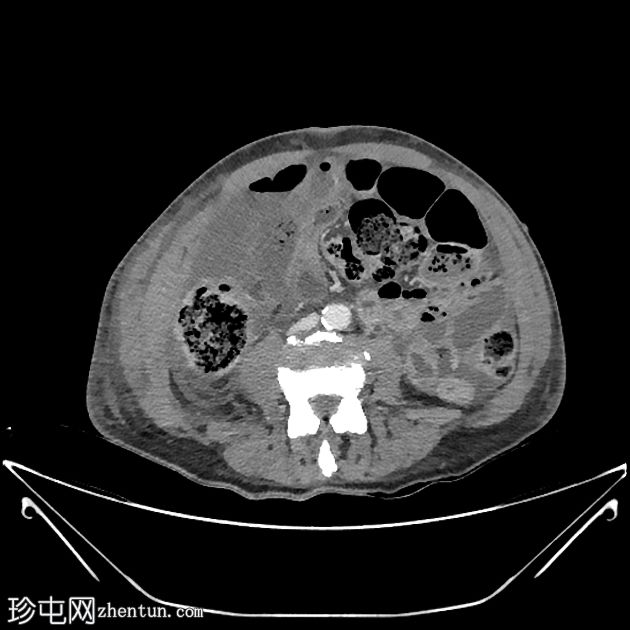内疝穿孔所致缺血性肠病