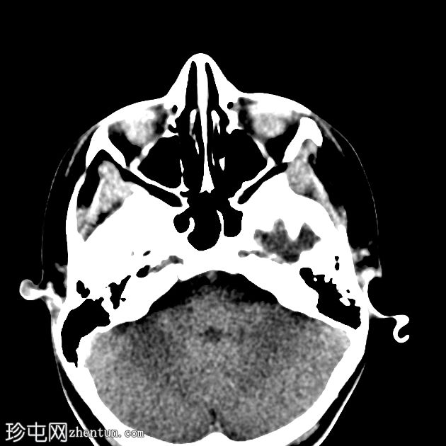 先天性耳道闭锁