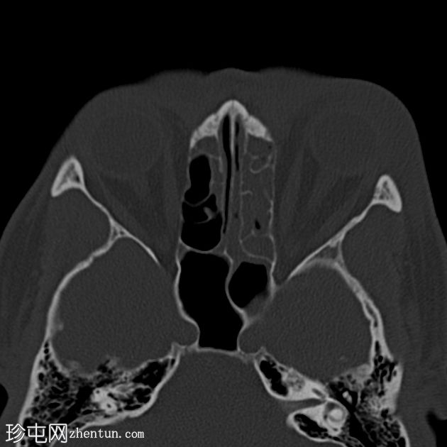 眶前蜂窝织炎