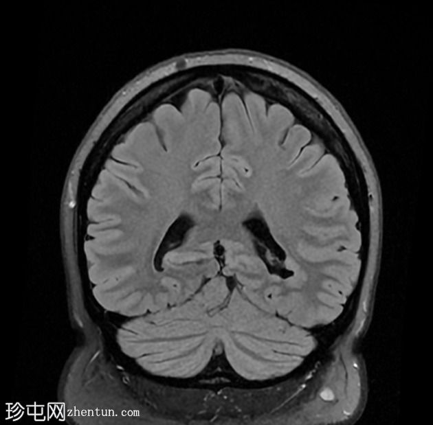 室管膜下灰质异位和持续开放前囟