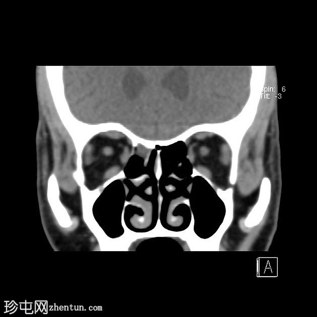 眼球破裂