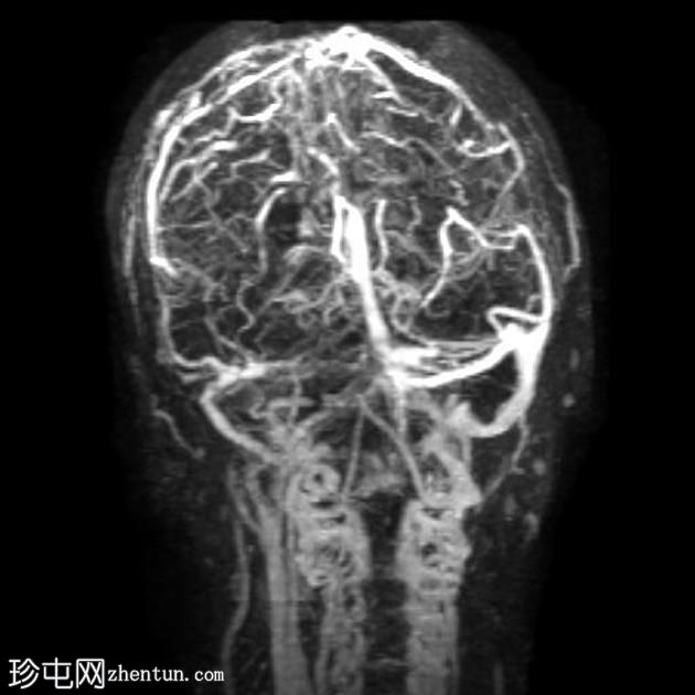 脑静脉窦血栓形成