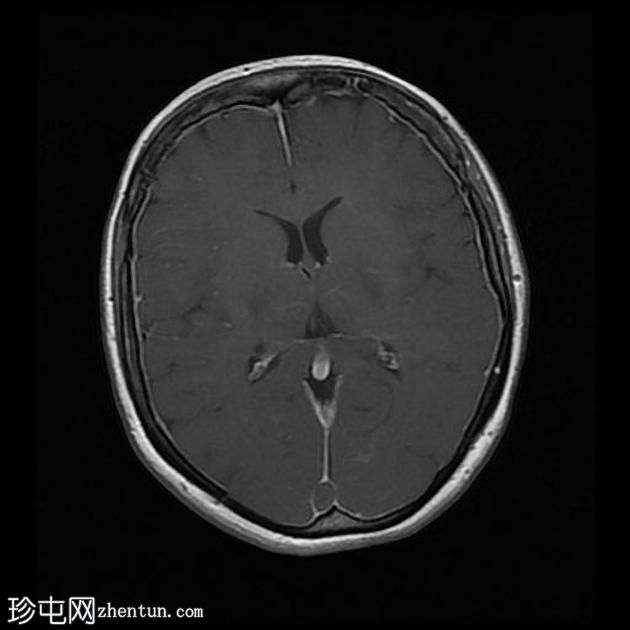 脑静脉窦血栓形成