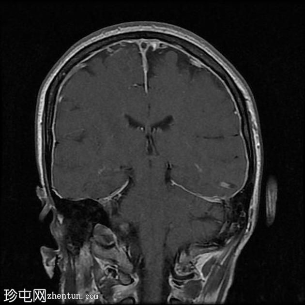 脑静脉窦血栓形成