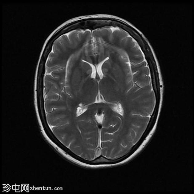 脑静脉窦血栓形成