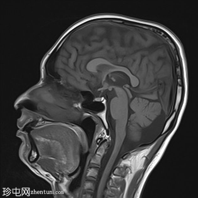 室管膜下灰质异位