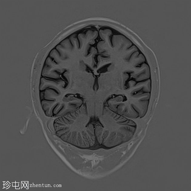 室管膜下灰质异位