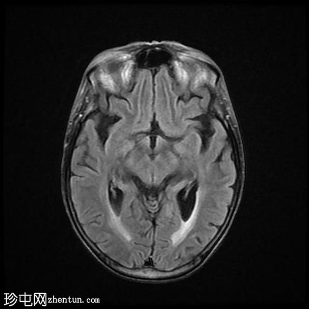 辐射诱导脑白质病