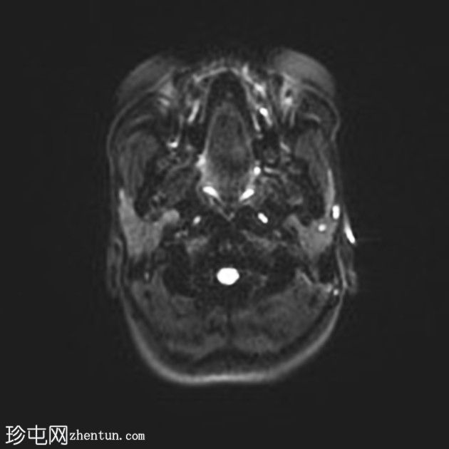 松果体细胞瘤